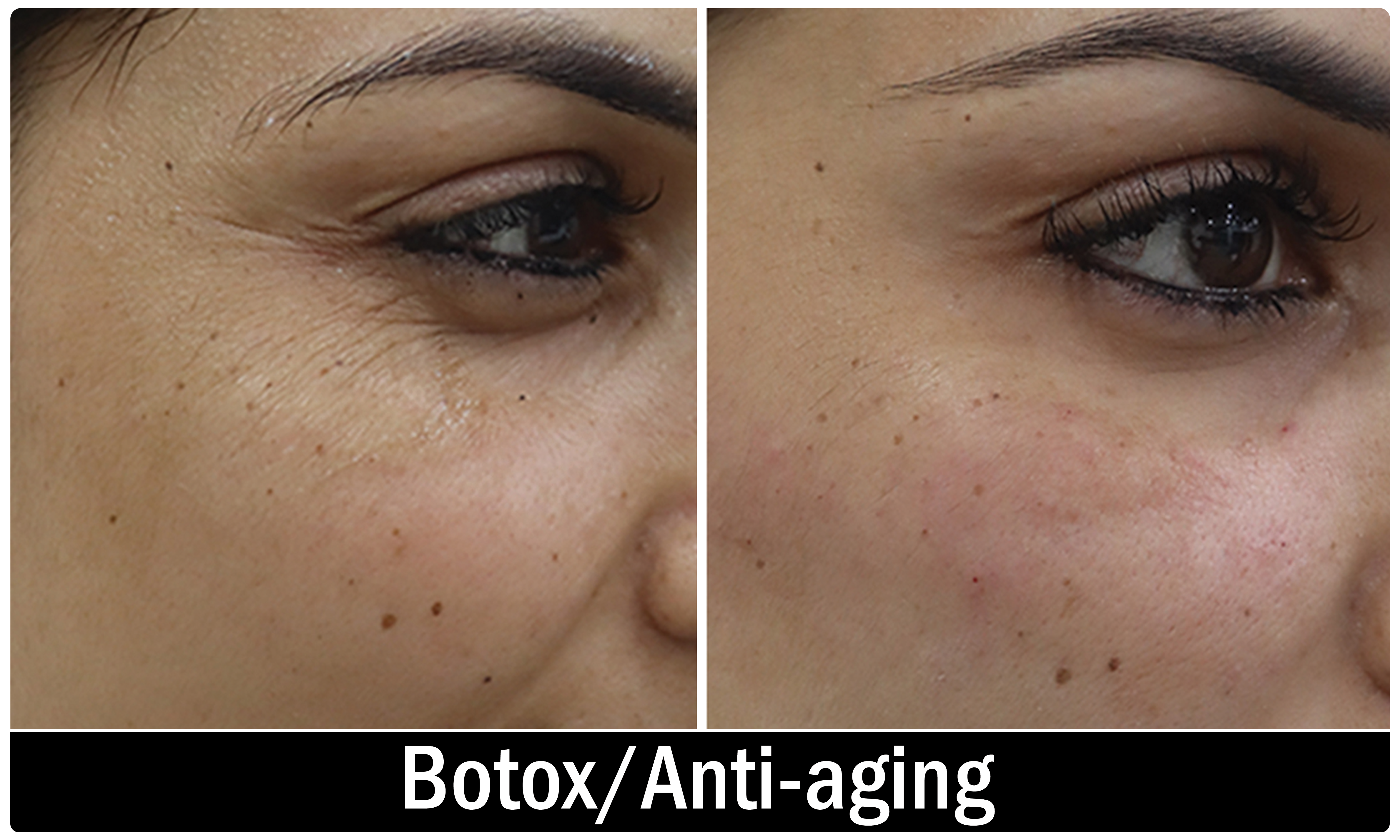 Botox result KOQ10